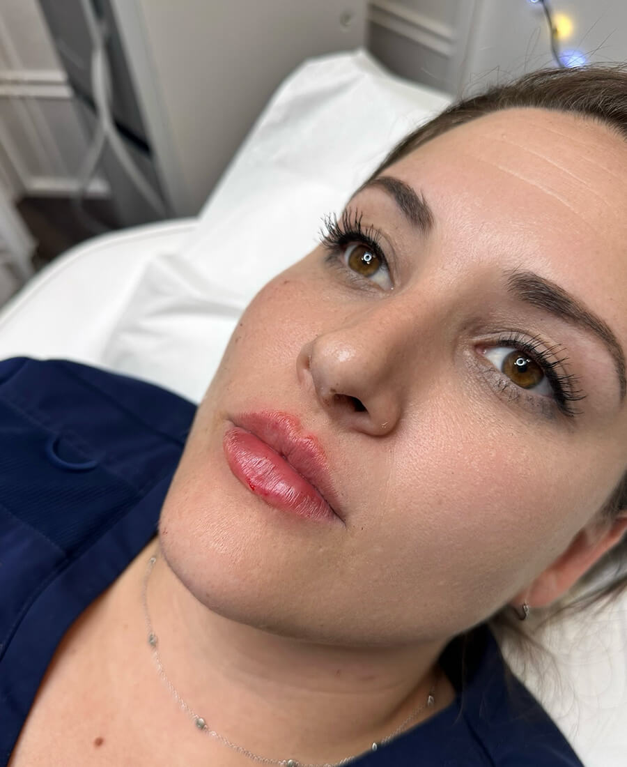 Case--2063 | After Lip Filler