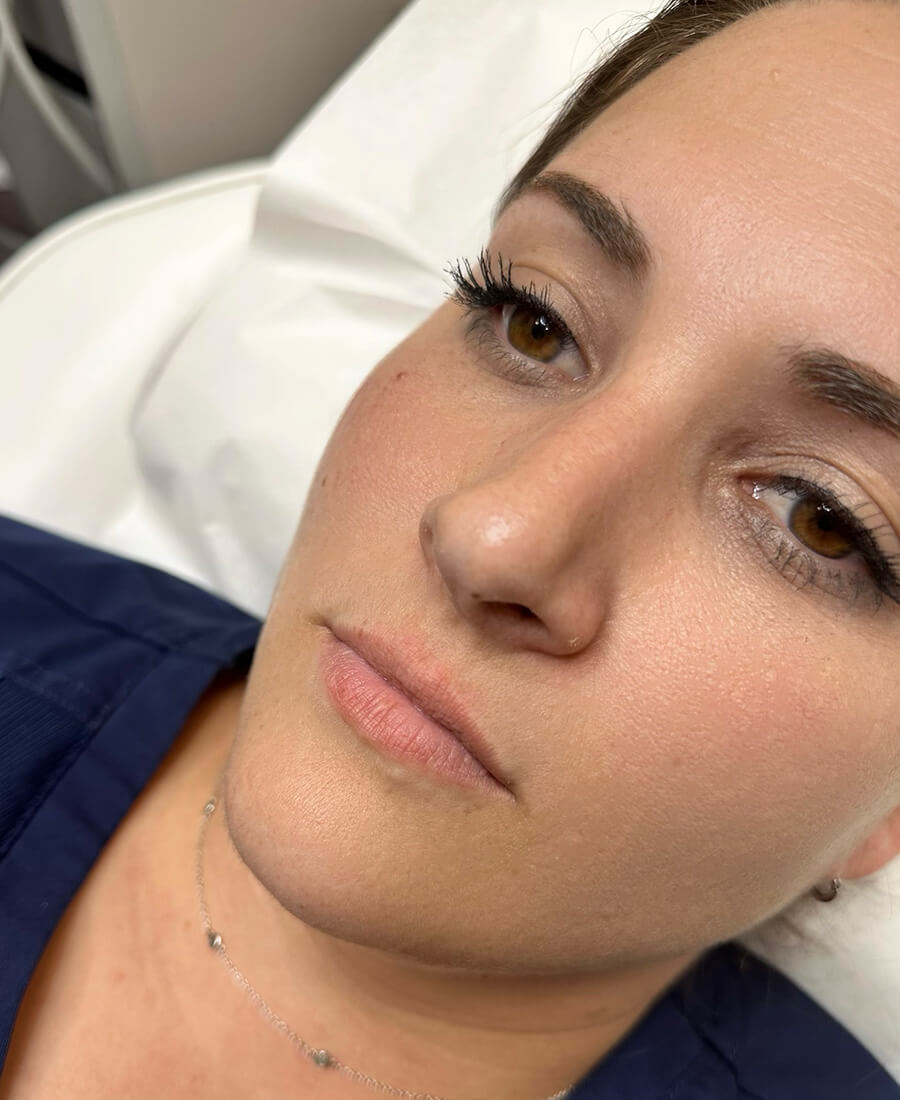 Case--2063 | Before Lip Filler