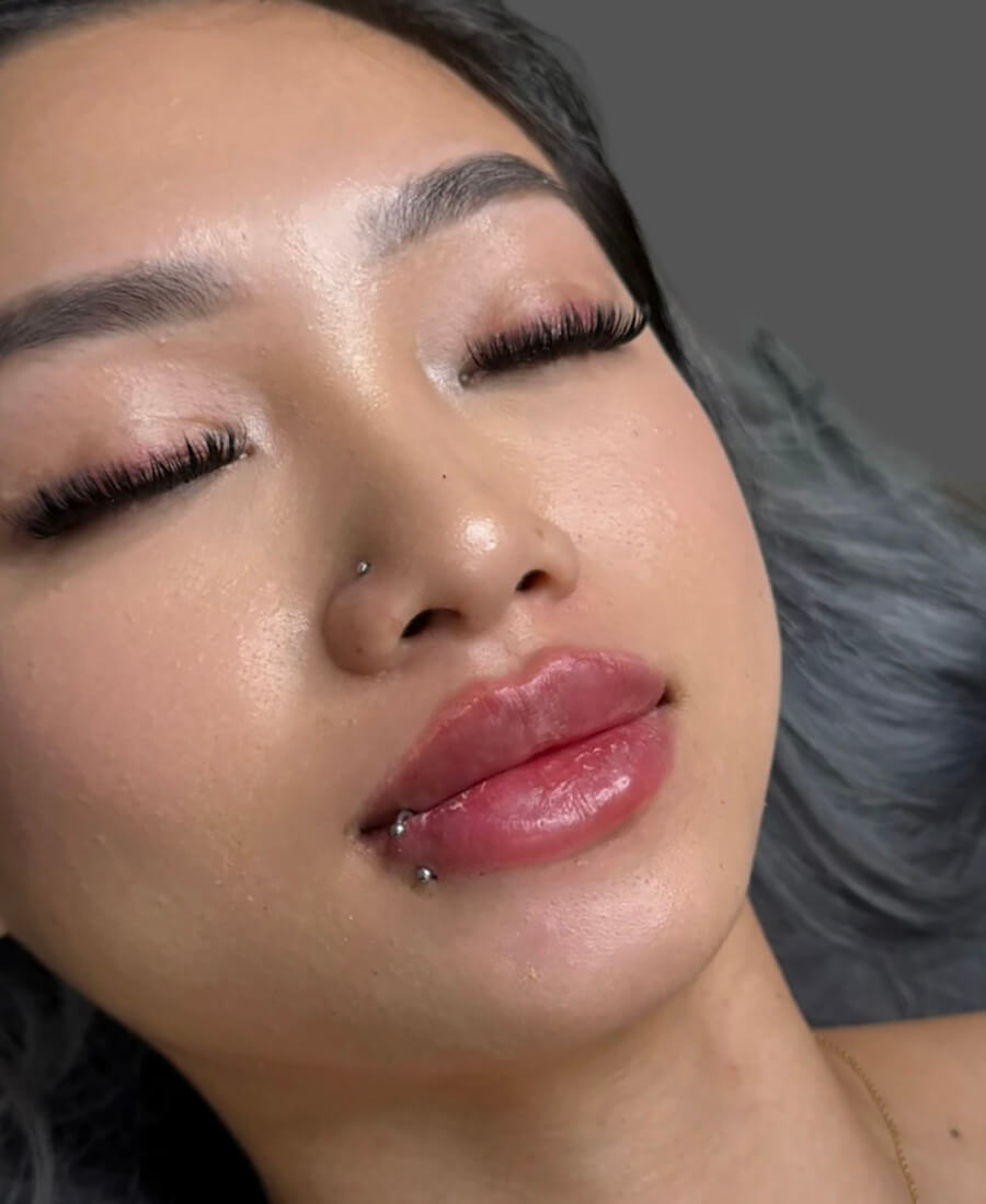 Case--8758 | After Lip Filler