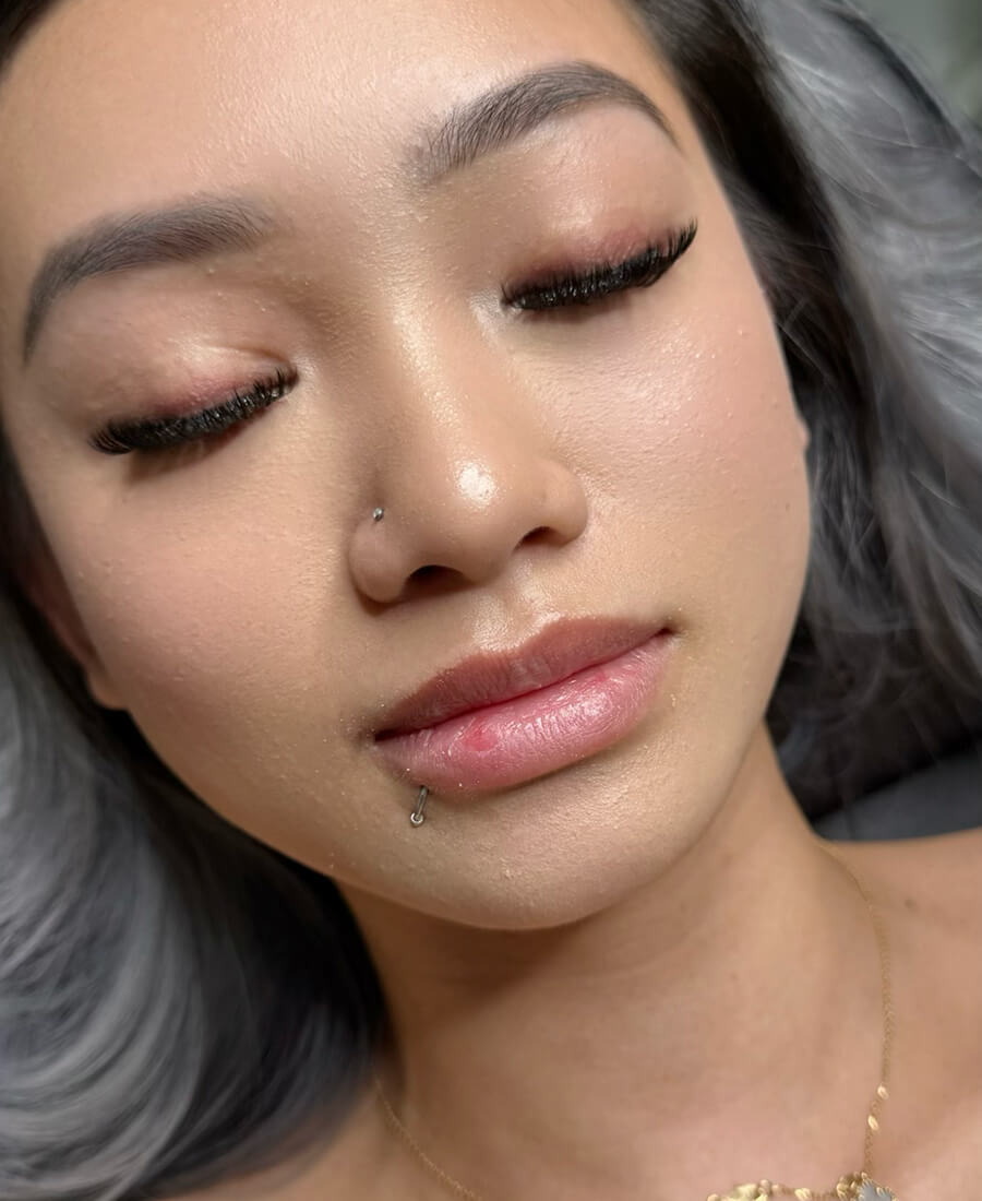 Case--8758 | Before Lip Filler