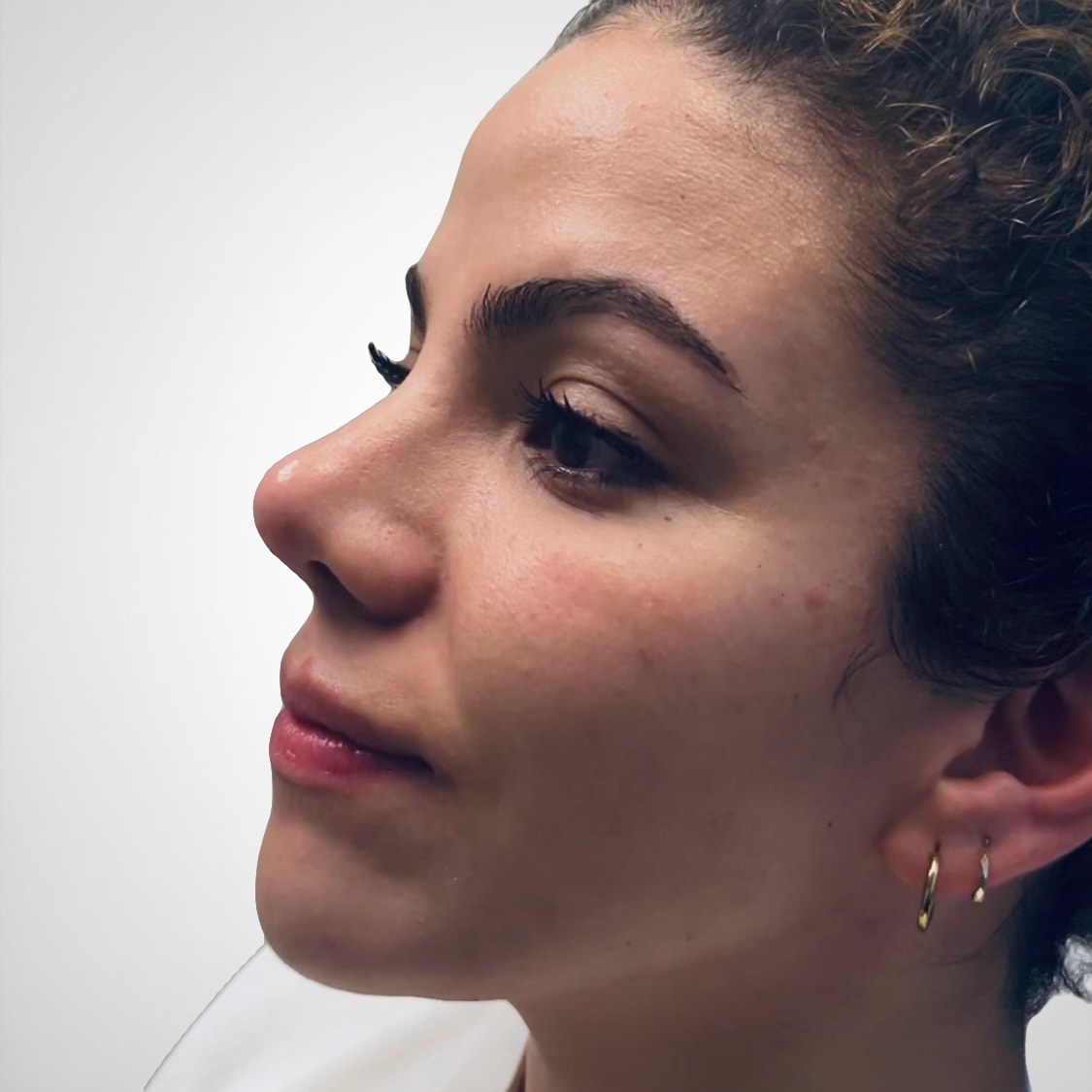 Liquid Rhinoplasty - After