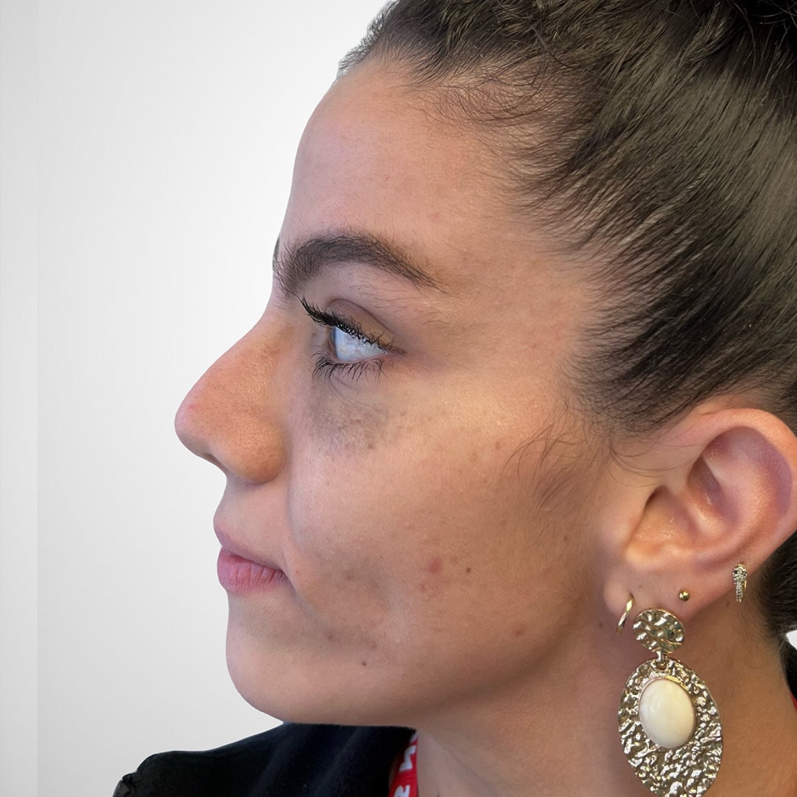 Liquid Rhinoplasty - Before