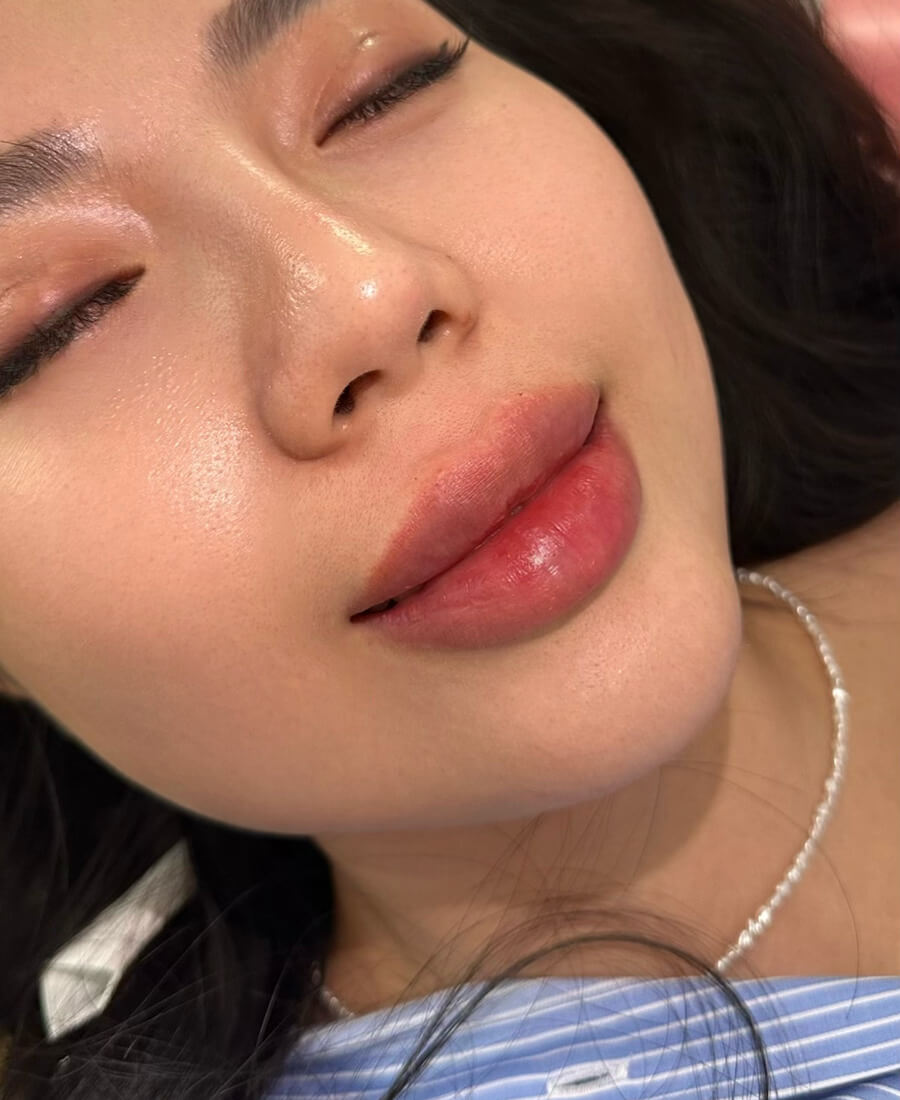 Case--1475 | After Lip Filler