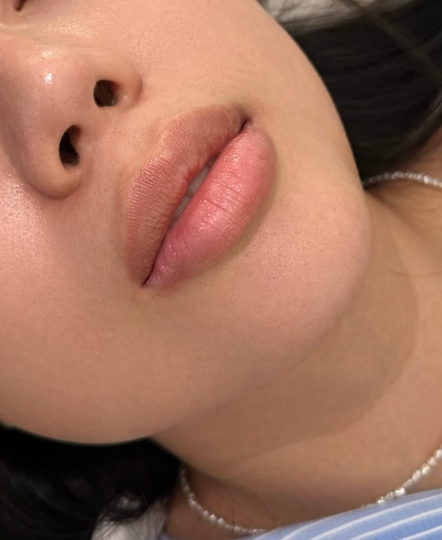 Case--1475 | Before Lip Filler