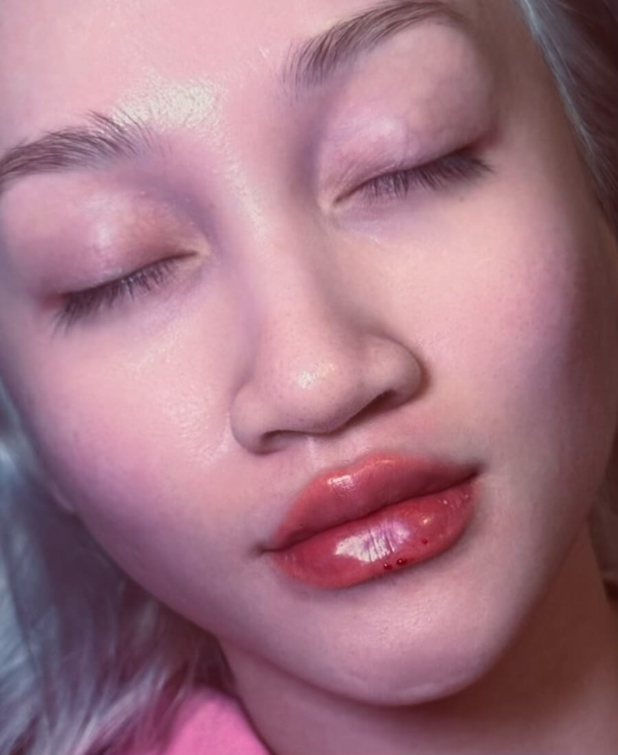 Case--6678 | After Lip Filler