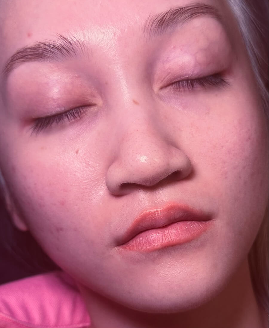 Case--6678 | Before Lip Filler