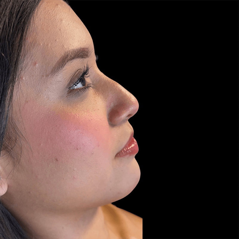 Case--6065 | Before Liquid Rhinoplasty