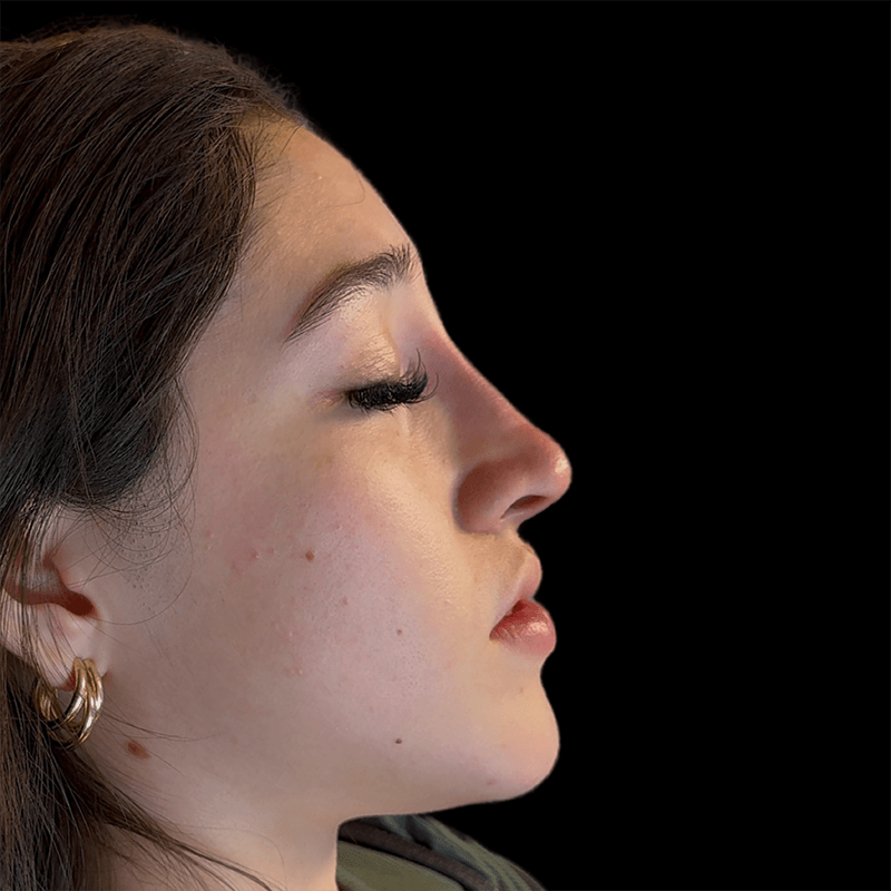 Case--8161 | After Liquid Rhinoplasty