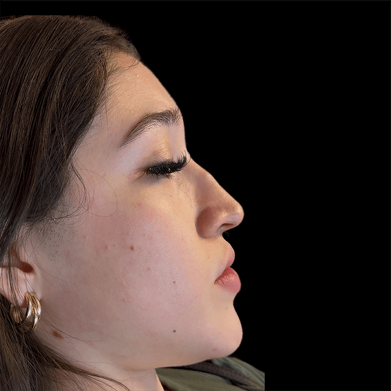 Case--8161 | Before Liquid Rhinoplasty