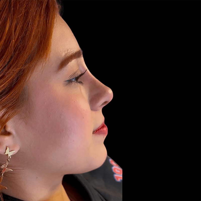 Case--3206 | After Liquid Rhinoplasty