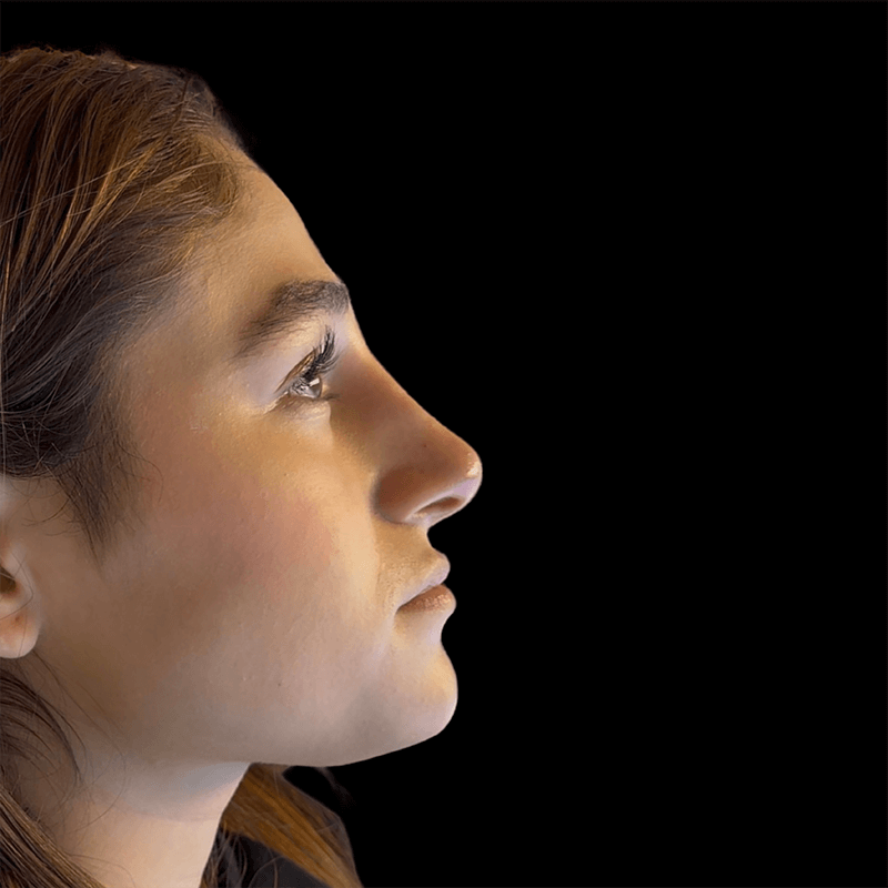 Case--3545 | After Liquid Rhinoplasty