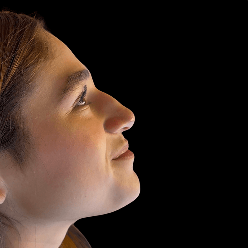 Case--3545 | Before Liquid Rhinoplasty