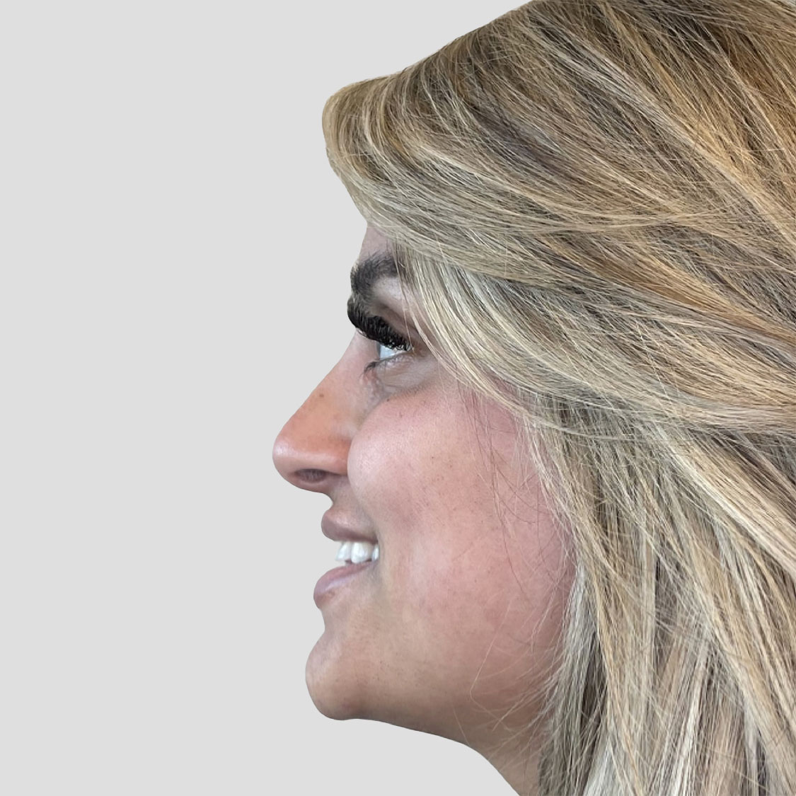Liquid Rhinoplasty - After