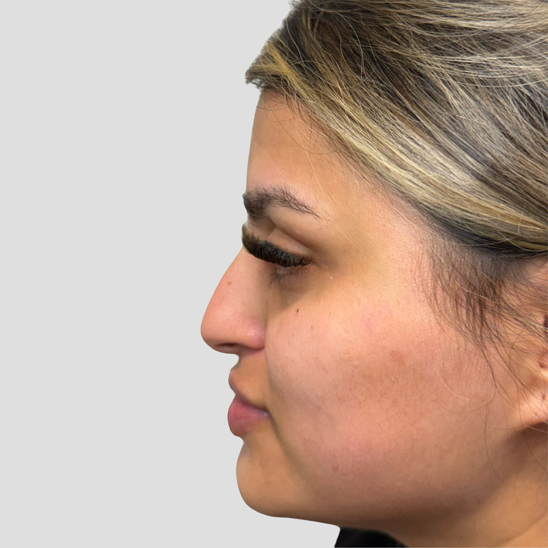 Liquid Rhinoplasty - Before